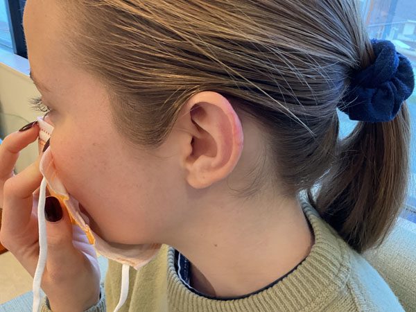 Mohs Ear Patient 12 After - 2