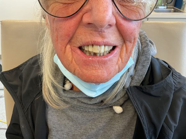 Mohs Lips Patient 09 After