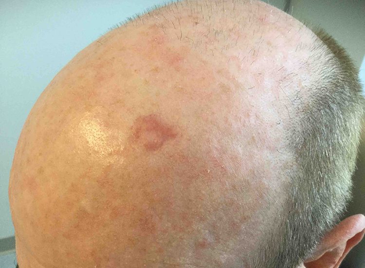 Mohs Patient Scalp 03 Before