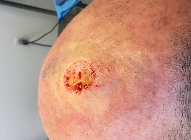 Mohs Patient Scalp 03 After