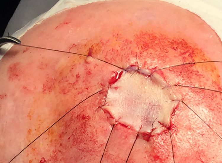 Mohs Patient Scalp 03 Before - 2