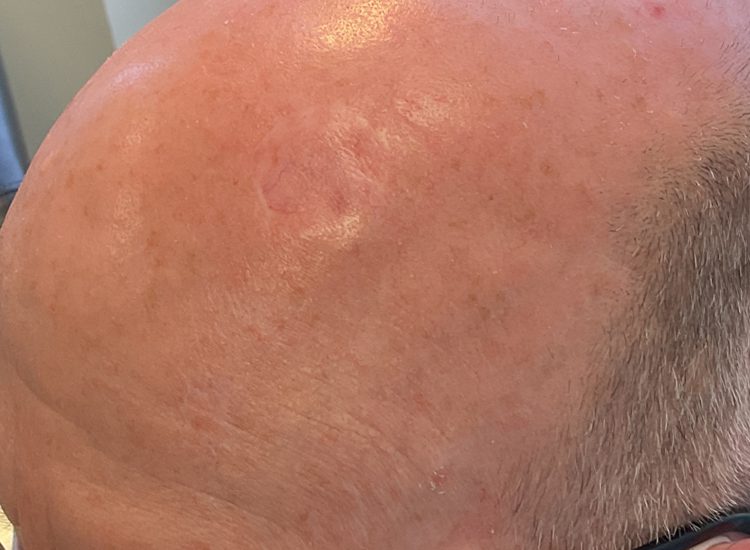 Mohs Patient Scalp 03 After - 2