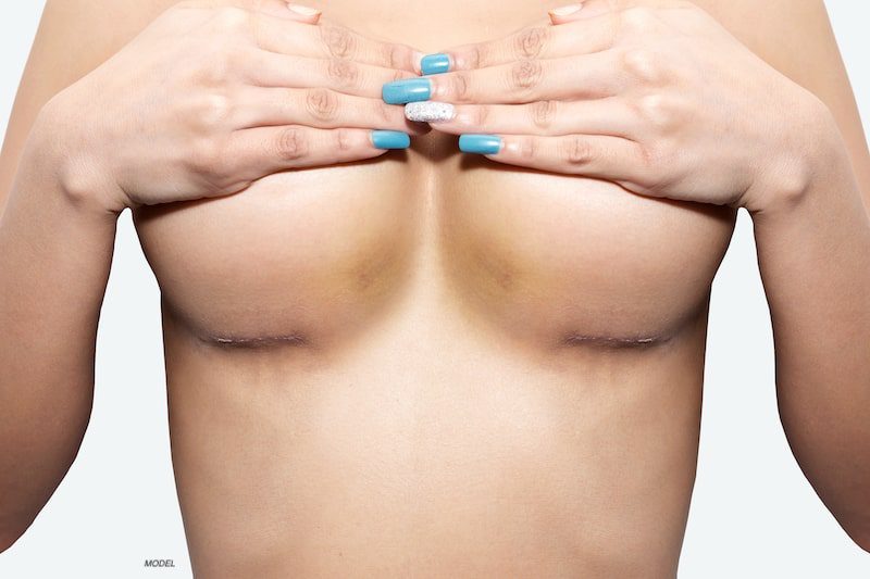 Topless woman with breast surgery scarring on the underside of her breasts