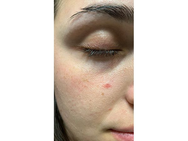 Mohs Face Patient 21 Before - 2