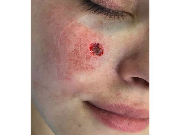 Mohs Face Patient 21 Before