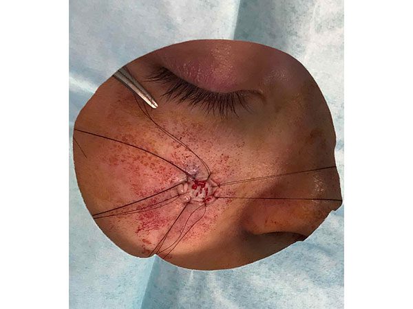 Mohs Face Patient 21 After