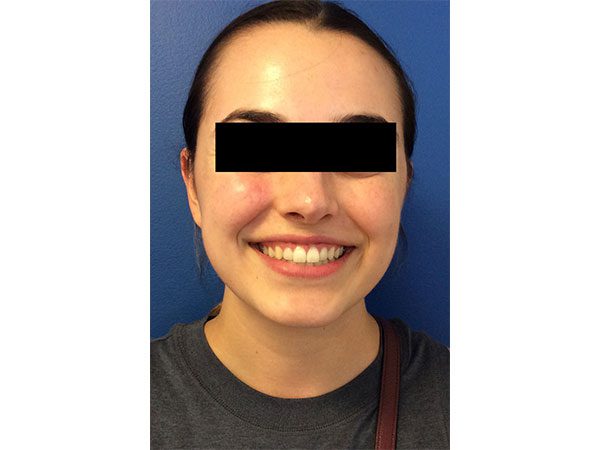 Mohs Face Patient 21 After - 2