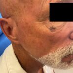 Mohs Eye Patient 07 Thumbnail After