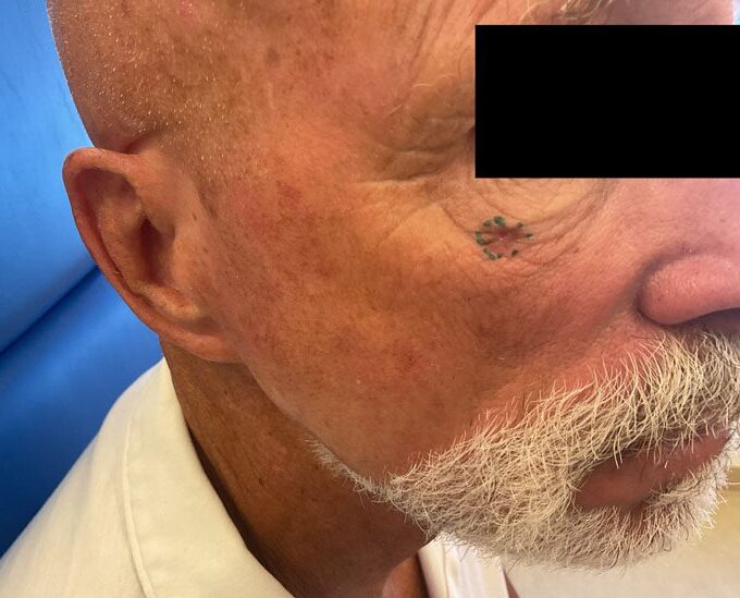 Mohs Eye Patient 07 After