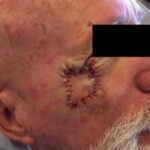 Mohs Eye Patient 07 Thumbnail Before