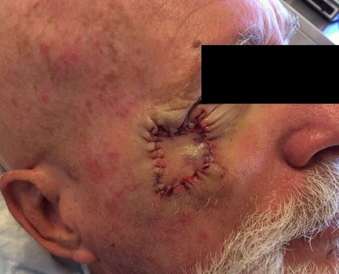 Mohs Eye Patient 07 Before