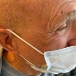 Mohs Eye Patient 07 Thumbnail Before - 2