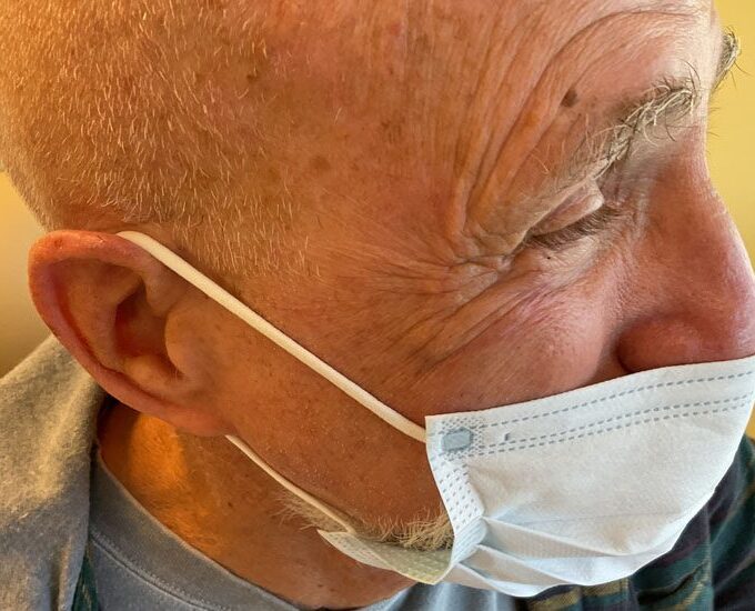 Mohs Eye Patient 07 Before - 2