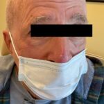 Mohs Eye Patient 07 Thumbnail After - 2