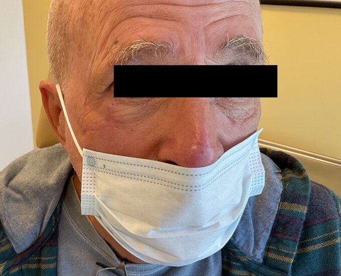 Mohs Eye Patient 07 After - 2