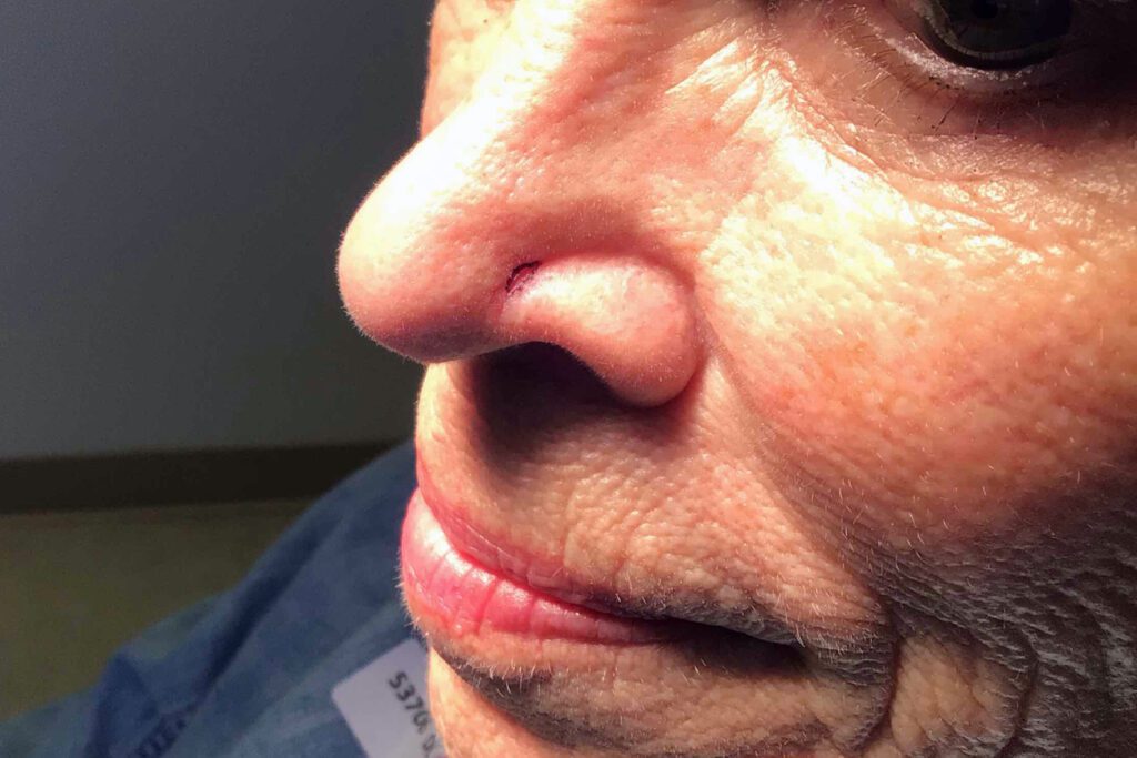 Mohs Nose Patient 26 Before