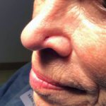 Mohs Nose Patient 26 Thumbnail Before