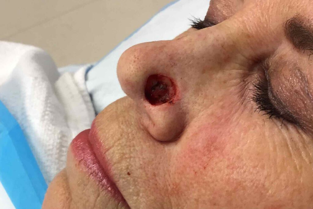 Mohs Nose Patient 26 After