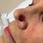 Mohs Nose Patient 26 Thumbnail After