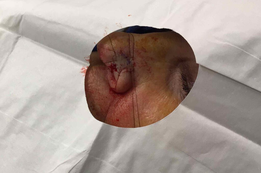 Mohs Nose Patient 26 Before - 2