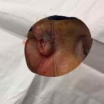 Mohs Nose Patient 26 Thumbnail Before - 2