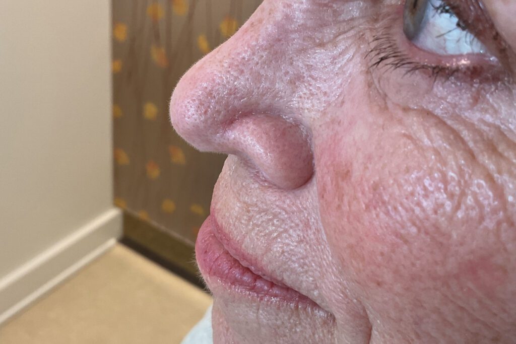 Mohs Nose Patient 26 After - 2