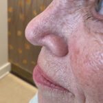 Mohs Nose Patient 26 Thumbnail After - 2