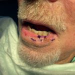 Mohs Lips Patient 13 Thumbnail Before