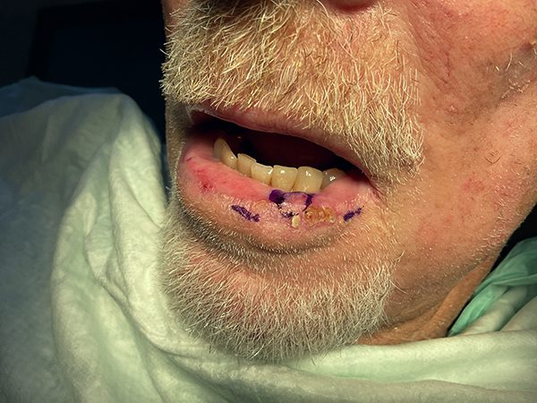 Mohs Lips Patient 13 Before