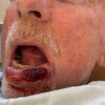 Mohs Lips Patient 13 Thumbnail After