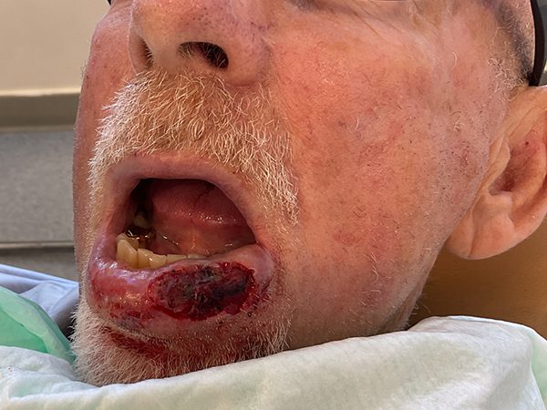 Mohs Lips Patient 13 After