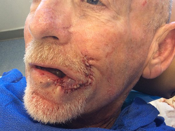 Mohs Lips Patient 13 Before - 2