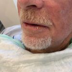 Mohs Lips Patient 13 Thumbnail After - 2