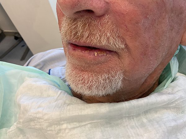 Mohs Lips Patient 13 After - 2