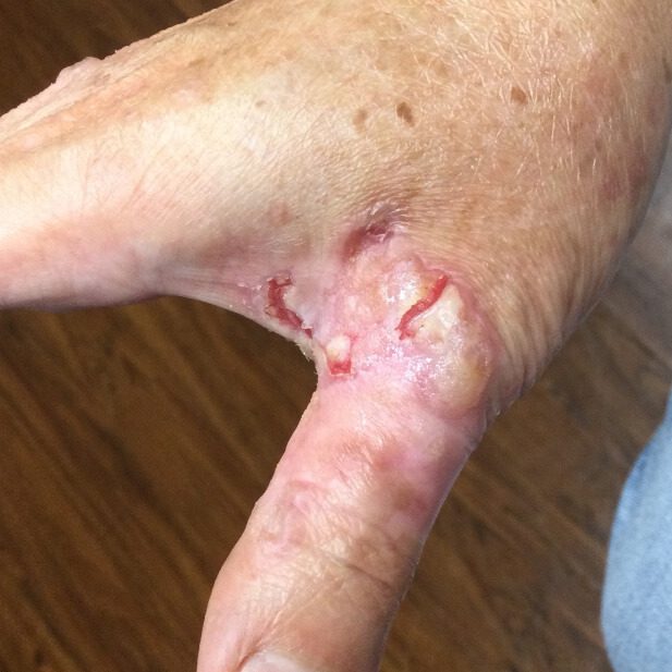 Mohs Hand Patient 1 Before