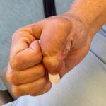 Mohs Hand Patient 1 Thumbnail After - 5