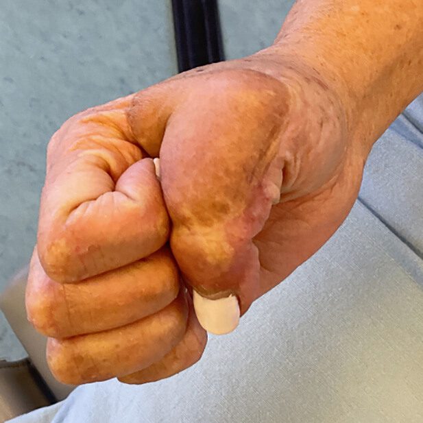 Mohs Hand Patient 1 After - 5