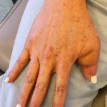 Mohs Hand Patient 1 Thumbnail After