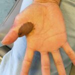 Mohs Hand Patient 1 Thumbnail After - 6