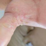 Mohs Hand Patient 1 Thumbnail Before - 2