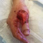 Mohs Hand Patient 1 Thumbnail Before - 3