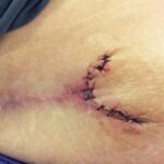 Mohs Hand Patient 1 Thumbnail After - 4