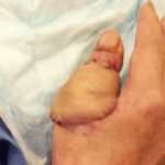 Mohs Hand Patient 1 Thumbnail Before - 5