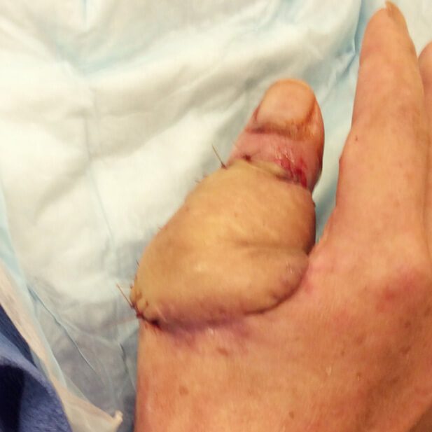 Mohs Hand Patient 1 Before - 5