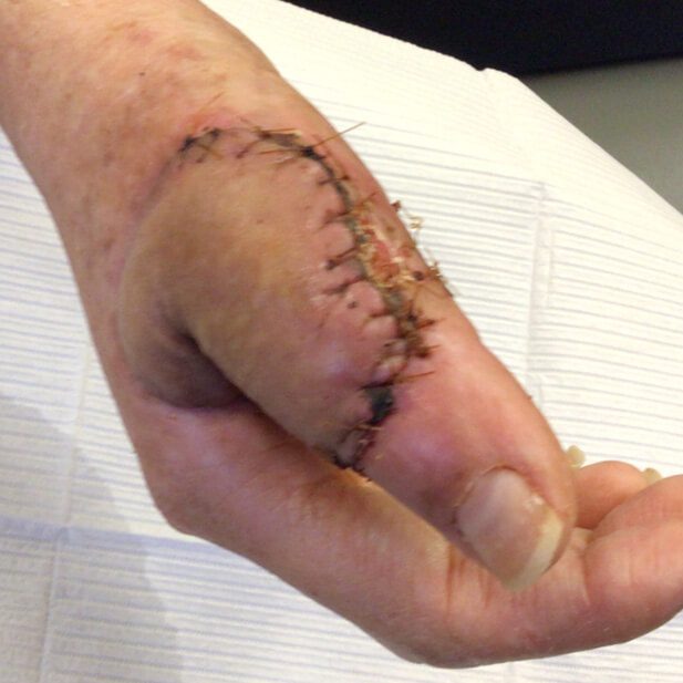 Mohs Hand Patient 1 After - 3