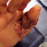 Mohs Hand Patient 1 Thumbnail After - 2