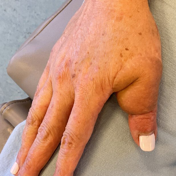 Mohs Hand Patient 1 Before - 6