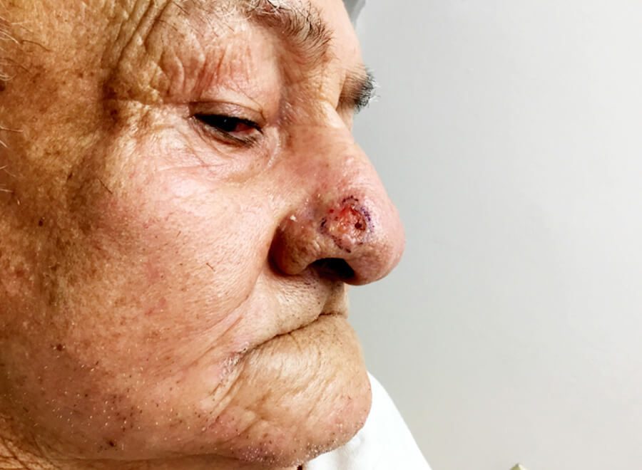 Mohs Nose Patient 27 Before