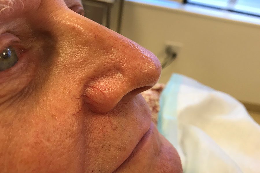 Mohs Nose Patient 28 Before