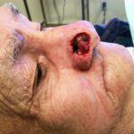 Mohs Nose Patient 27 Thumbnail After